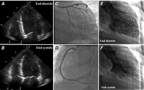 severe hypokinesis of inferior wall.